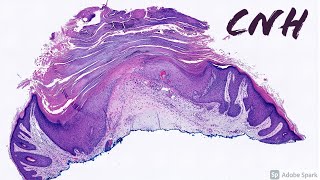 CNH Chondrodermatitis Nodularis Helicis Dermatology Mimic of Squamous Cell Carcinoma of Ear [upl. by Broida]