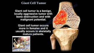 Giant Cell Tumor  Everything You Need To Know  Dr Nabil Ebraheim [upl. by Alhan]