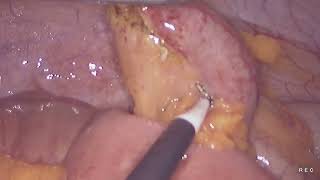 Laparoscopic appendectomy unedited 882024 [upl. by Sato]