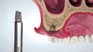 iRaise sinus lift system [upl. by Sulrac]