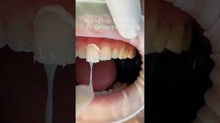 No prep veneers by cosmetic dentist Dr Tejas Patel austinveneers smilemakeover [upl. by Noryd]