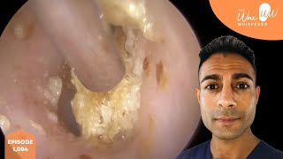 1084  Post Swimming Blocked Ear Wax Removal [upl. by Usanis]