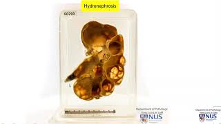 Kidney Hydronephrosis with clinicopathologic correlates [upl. by Ruthie21]