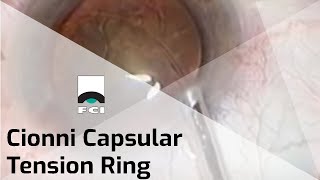 Cionni CTR  Capsular Tension Ring  Presentation  FCI Cataract [upl. by Godrich]