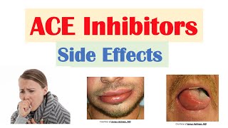 ACE Inhibitor Side Effects Lisinopril Ramipril Captopril Perindopril  Causes and Why They Occur [upl. by Ilehs]