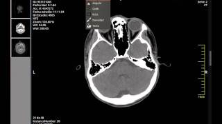 Multiplatform Dicom Viewer [upl. by Storz136]