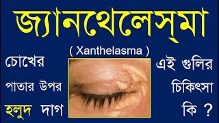 XanthelasmaSymptoms and treatment xanthelasma xanthelasmTreatment xanthelasmaEye doctorSight [upl. by Eatnhoj]