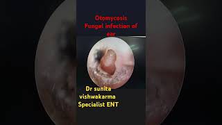 otomycosis fungal infection of 👂earentfungalinfectionotomycosisrainyseasonhumidity [upl. by Inah]