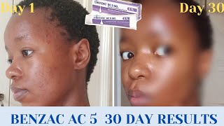 Benzac ac 5 Benzoyl Peroxide 30 DAY review  what you need to know  South African YouTuber [upl. by Ibok180]