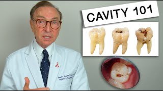 What Causes Tooth Decay Cavity 101  Causes  Treatment [upl. by Aleinad373]