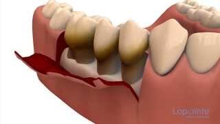 Parodontie par lambeaux  Centres dentaires Lapointe [upl. by Obocaj]