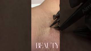 Ingrown Hair Removal [upl. by Limoli]