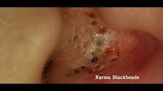 Senile comedones Spreading Blackheads  Removal [upl. by Lareena]