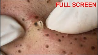 Blackheads Removal  Best Pimple Popping Videos [upl. by Shantha]