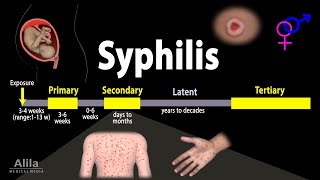 Syphilis  Pathophysiology Diagnosis and Treatments Animation [upl. by Gutow]