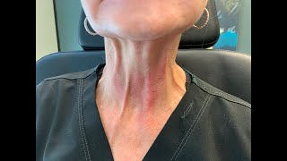 Injecting Botox in the Neck to relax neck bands [upl. by Akinihs]