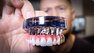 DENTURES vs Dental IMPLANTS Full Mouth Rehabilitation  See the Smile Transformation [upl. by Ardelis154]