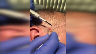 Seborrhoeic Keratosis Removal Demo [upl. by Stulin]