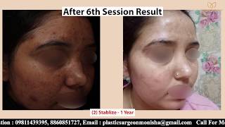 Get Rid Of Pigmentation In 6 Sessions  Step By Step Guide  Dr Monisha Kapoor [upl. by Maurits559]