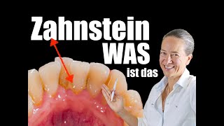 ZAHNSTEIN WAS ist das Was kann ich dagegen tun [upl. by Alad]