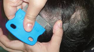 picking dry patchy scabs  scalp scratching  asmr [upl. by Ecadnac]