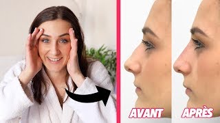 MON NOUVEAU NEZ ma rhinoplastie médicale [upl. by Onailime]