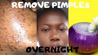 How To Remove Pimples Overnight  Acne Treatment  With Onions [upl. by Harvie]