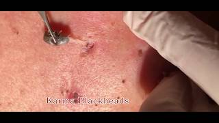 Triple Blackheads comedones removal  2019 [upl. by Gothurd428]