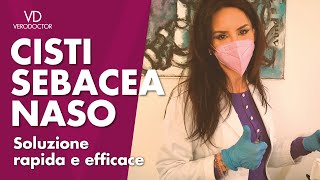 Rimozione cisti sebacea un intervento rapido ed efficace  VERODOCTOR [upl. by Occor]