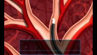 Airway Bypass Stenting for Severe Emphysema 1 [upl. by Ayaros38]