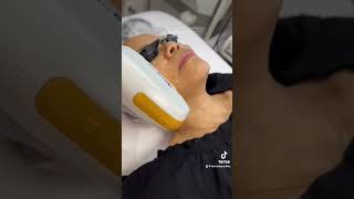 IPL Photofacial treatment for Pigmentation Removal [upl. by Eniortna]