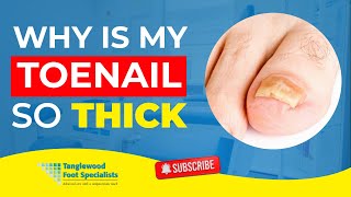 Why Is My Toenail So Thick [upl. by Magocsi]