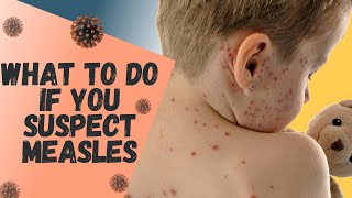 What to do if you think you or your child has MEASLES [upl. by Mcclees]