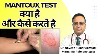 Mantoux Test क्या है और कैसे करते है  Mantoux tuberculin skin test TST TB Test  Diagnosis of TB [upl. by Felita]