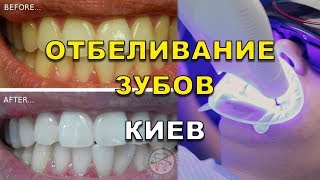 Отбеливание зубов в стоматологии Киев видео ЛюмиДент відбілювання зубів Київ [upl. by Suiravad]