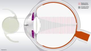 Tiefenschärfesteigernde Linsen EDOFIntraokularlinsen [upl. by Gillian]