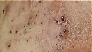 Giant blackheads on the Face Part 02 [upl. by Vickie556]