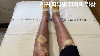 Vlog  희귀 피부병 환자의 일상  희귀병브이로그  투병생활  수포성표피박리증  Dystrophic Epidermolysis Bullosa [upl. by Ahsatak171]