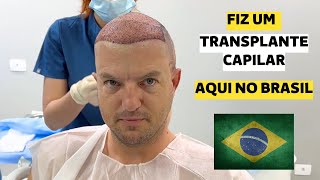 TUDO SOBRE MEU TRANSPLANTE CAPILAR [upl. by Sivraj]