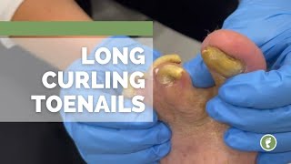 LONG CURLING TOENAILS [upl. by Burrow651]