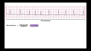 Determine HR from an IrregularRhythm EKG  6second Method [upl. by Margaux]