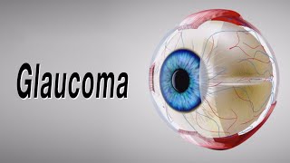 Glaucoma Animation of Why It Happens and How It Can Cause Blindness [upl. by Schear909]