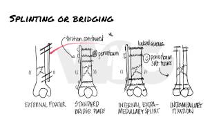 Principles of Fracture Fixation  Orthopedic Basics [upl. by Sedgewinn93]