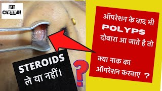 steroid use in recurrent Nose Polyps  naak ka maans badna [upl. by Hirza750]