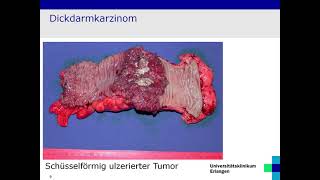 Pathologie und Molekularpathologie des kolorektalen Karzinoms Prof Dr med Arndt Hartmann [upl. by Willis]