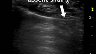 Pneumothorax on ultrasound  Important [upl. by Chelsie]