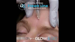 Deeper frown lines Treatment with Botox and filler [upl. by Rexferd]