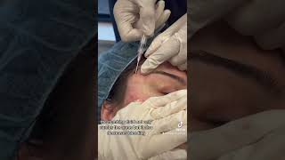 Subcision for Acne Scars of the Cheeks and Temples [upl. by Aelanej]