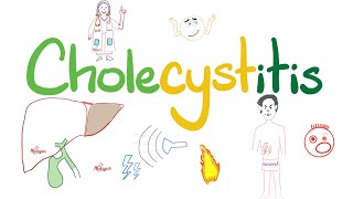 Cholecystitis  A Tale of One Cholelith  The most COMPREHENSIVE Review [upl. by Analed51]