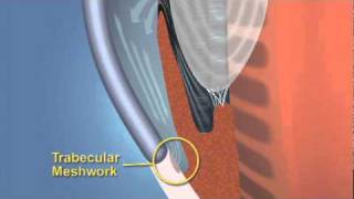 Closed Angle Glaucoma [upl. by Eyar945]